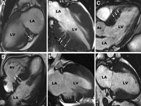 lv crypt|hypokinesis and myocardial thinning.